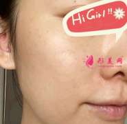 上海韓嘯整形醫(yī)院光子嫩膚案例 皮膚好水潤(rùn) 瑕疵都不見(jiàn)啦