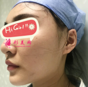 上海第九人民醫(yī)院整形科下頜角磨骨案例分享 側面看美翻了