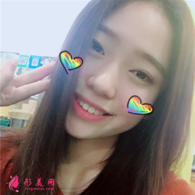 海南小姐姐吸脂瘦臉術(shù)后案例反饋