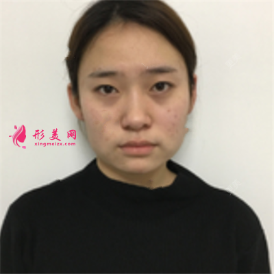 海南小姐姐吸脂瘦臉術(shù)后案例反饋