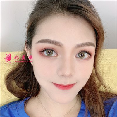 南寧眼部綜合手術(shù)術(shù)后效果分享