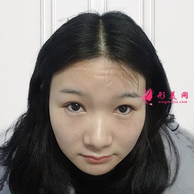 武漢眉毛種植手術(shù)術(shù)后恢復(fù)效果分享