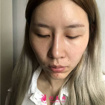 泉州鼻綜合術(shù)后恢復(fù)效果對(duì)比