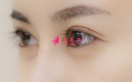 割雙眼皮的手術(shù)費(fèi)用是多少呢