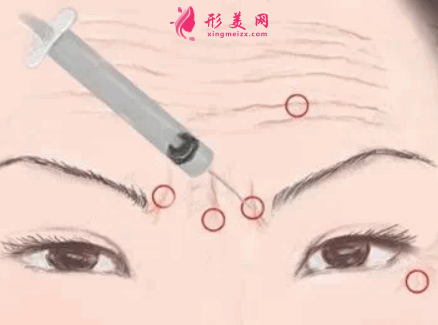 愛貝芙注射除皺前要注意什么