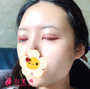 北京潤美玉之光醫(yī)療美容醫(yī)院雙眼皮修復后拯救了我，瞬間變女神