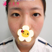 廣州曙光醫(yī)學美容醫(yī)院眼綜合案例分享 眼型很精致 變化好大呀