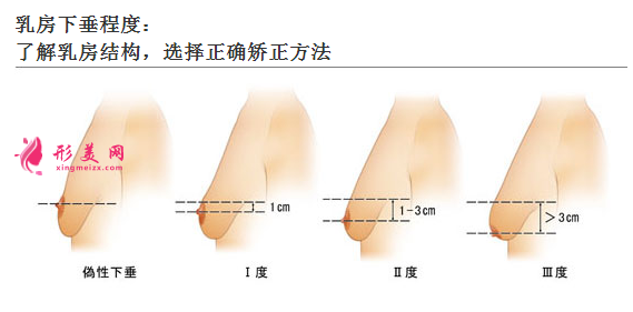 胸部下垂矯正手術(shù)多少錢