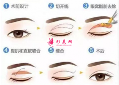 切雙眼皮一般需要多少錢？