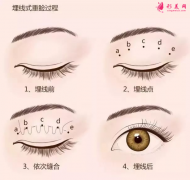埋線雙眼皮一般多久恢復(fù)正常？