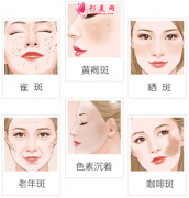 激光祛斑恢復(fù)期如何護(hù)理?