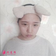成都軍大整形注射瘦臉針瘦臉術(shù)后效果對比？