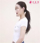 廣州華美醫(yī)療美容醫(yī)院小姐姐假體隆胸術(shù)后恢復(fù)效果對(duì)比