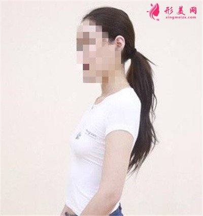 廣州小姐姐假體隆胸術(shù)后恢復(fù)效果對比