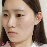 廣州華美醫(yī)療美容醫(yī)院小姐姐切開雙眼皮術(shù)后效果分析