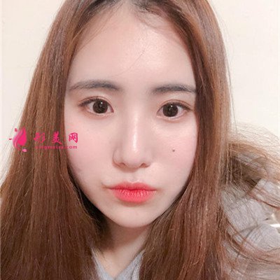 上海小姐姐切開雙眼皮術(shù)后效果分析