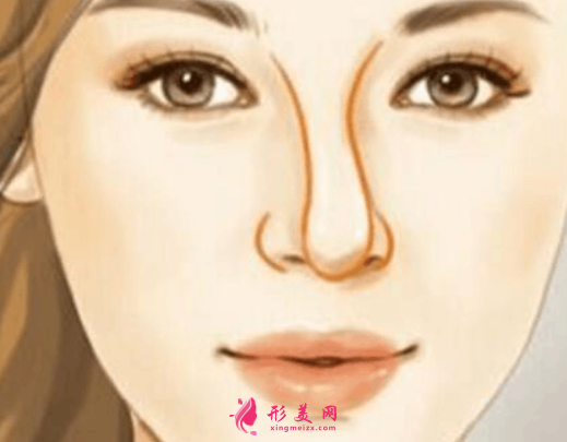 隆鼻歪了怎么修復