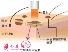 激光祛黃褐斑還會再長嗎？