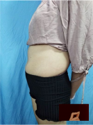 北京純脂醫(yī)療美容腰腹吸脂手術(shù)術(shù)后效果分享
