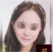 上海九院磨骨案例3個月圖，我做了精致度滿分的“上鏡臉”！
