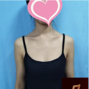 上海九院假體隆胸效果怎么樣？手術(shù)費(fèi)貴不？