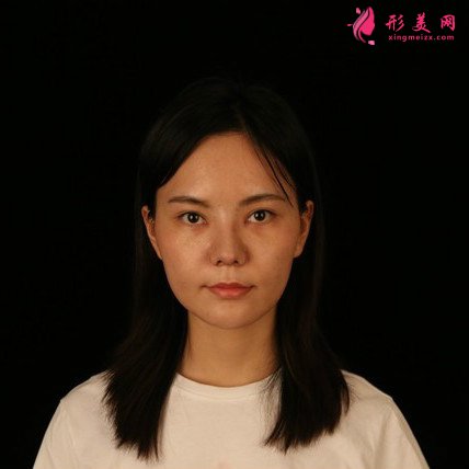 女人無需傾國傾城的整形術(shù)后圖片