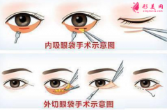 手術(shù)祛眼袋后眼眶凹陷能修復(fù)嗎？
