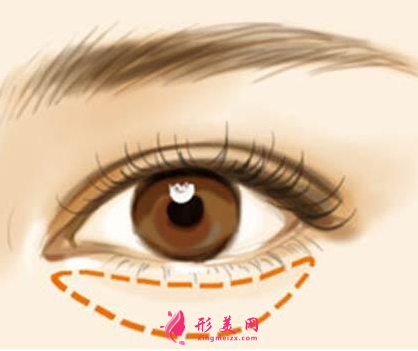 祛眼袋手術(shù)失敗會(huì)出現(xiàn)什么問(wèn)題