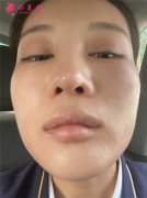 北京煤炭總醫(yī)院整形美容中心鼻綜合手術術后恢復情況分析