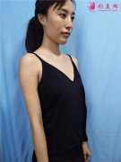 上海九院自體脂肪隆胸怎么樣？小姐姐脂肪胸案例分享