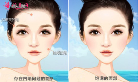 自體脂肪填充臉部可以保持多久