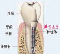 種植牙可以使用多久？