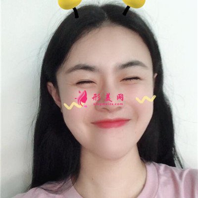 長(zhǎng)沙鼻綜合手術(shù)恢復(fù)情況對(duì)比