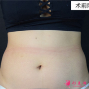 北京禾美嘉醫(yī)療美容腰腹吸脂術(shù)后恢復(fù)情況分析