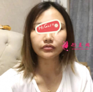 上海首爾麗格醫(yī)整形醫(yī)院顴骨內推術心得分享 效果很驚喜 秒變女神