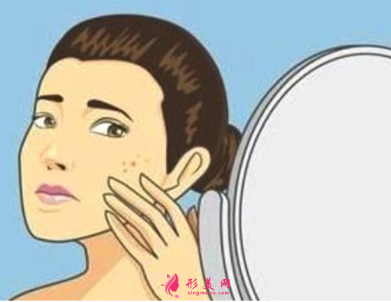 怎么樣才能祛除臉上痘印呢