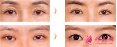 雙眼皮術(shù)后疤痕不消的原因有哪些？