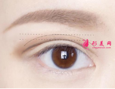 切開(kāi)雙眼皮術(shù)后的護(hù)理工作怎么做