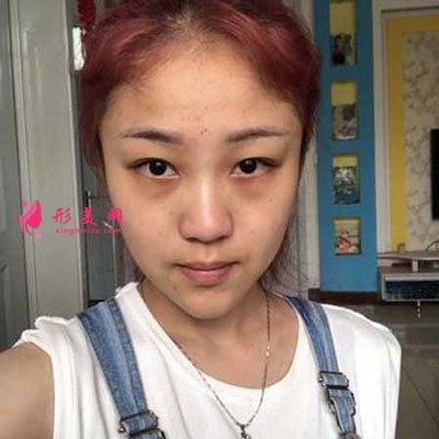 西安美萊整形美容醫(yī)院隆鼻手術(shù)的案例