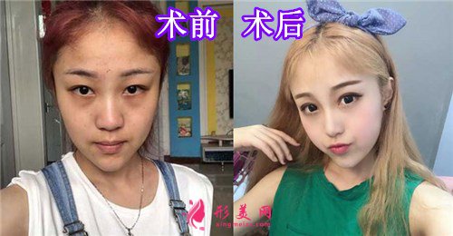 西安美萊整形美容醫(yī)院隆鼻手術(shù)的案例