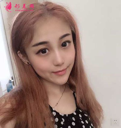 西安美萊整形美容醫(yī)院隆鼻手術(shù)的案例