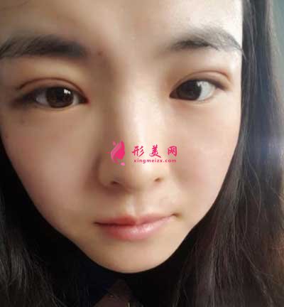 找八大處王太玲醫(yī)生做雙眼皮手術(shù)