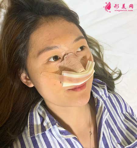 大連醫(yī)科大學(xué)第二附屬醫(yī)院整形外科做隆鼻一個月經(jīng)歷分享