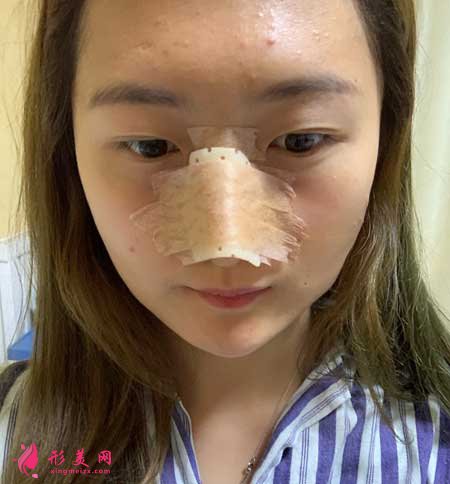 大連醫(yī)科大學(xué)第二附屬醫(yī)院整形外科做隆鼻一個月經(jīng)歷分享