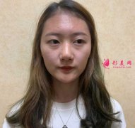 大連醫(yī)科大學(xué)第二附屬醫(yī)院整形外科做隆鼻一個月經(jīng)歷分享