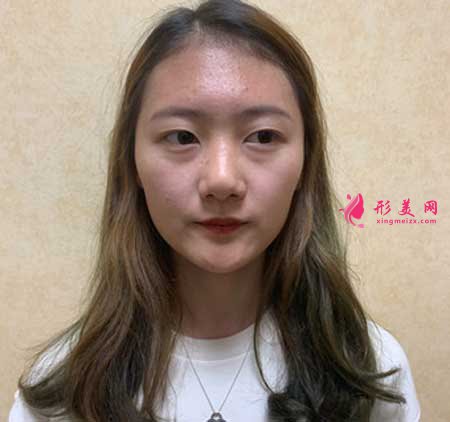 大連醫(yī)科大學(xué)第二附屬醫(yī)院整形外科做隆鼻一個月經(jīng)歷分享