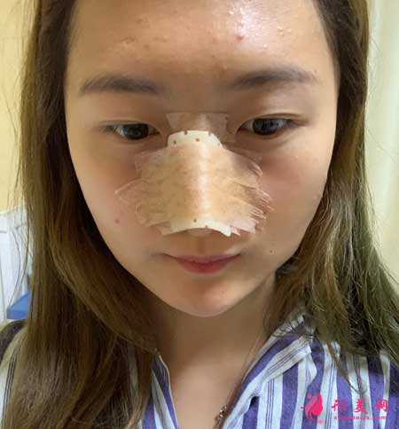 大連醫(yī)科大學(xué)第二附屬醫(yī)院整形外科做隆鼻一個(gè)月經(jīng)歷分享