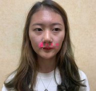 大連醫(yī)科大學第二附屬醫(yī)院整形外科做隆鼻一個月經(jīng)歷分享