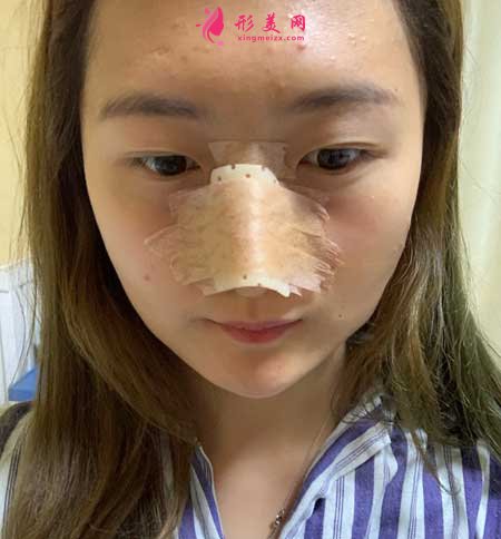 大連醫(yī)科大學(xué)第二附屬醫(yī)院整形外科做隆鼻一個(gè)月經(jīng)歷分享