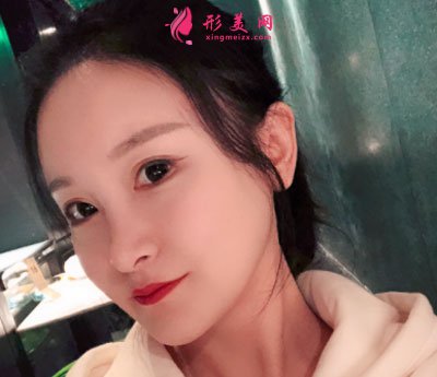 上海華美醫(yī)療美容醫(yī)院V-LINE瓜子臉手術(shù)案例
